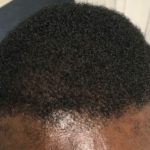 Does Afro Hair Transplant Work?